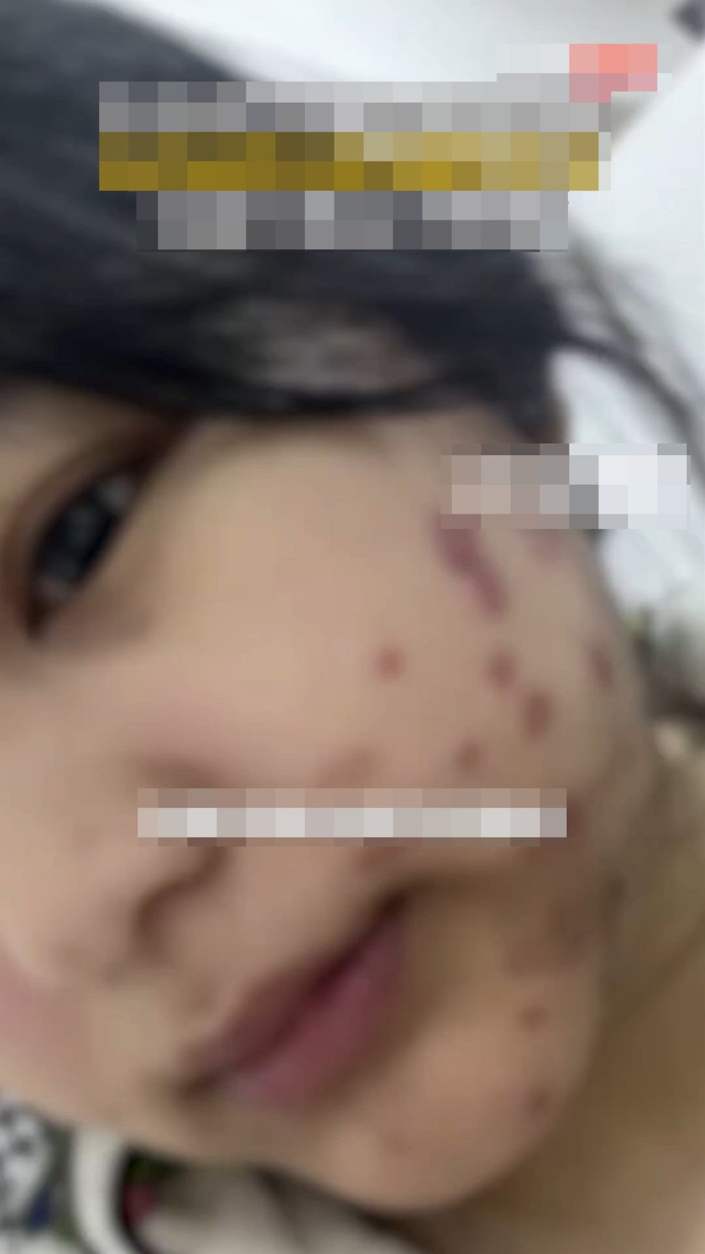 事主被感染貓癬，全身出現紅疹。微博@小莉幫忙