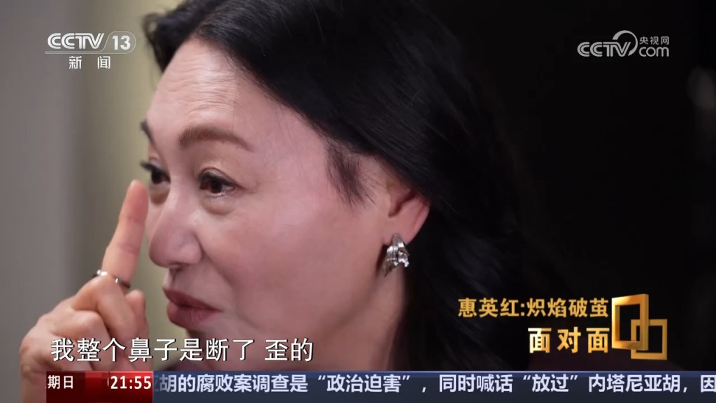 惠英紅指當時她的鼻樑斷裂，不能呼吸。