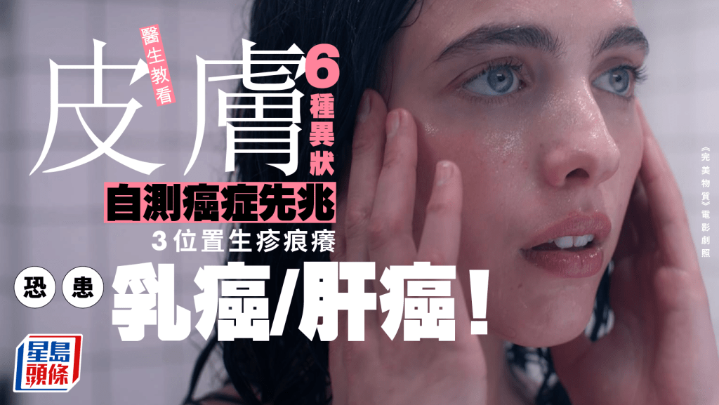看皮膚6種異狀自測癌症先兆 醫生揭3位置生疹痕癢 恐患乳癌/肝癌！