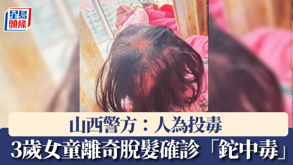 3歲女童離奇嚴重脫髮確診「鉈中毒」。