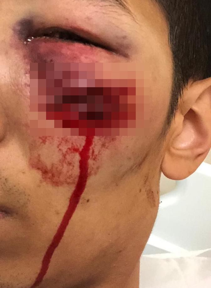 男子被橡膠彈擦面而過，血痕至少3厘米長。網圖
