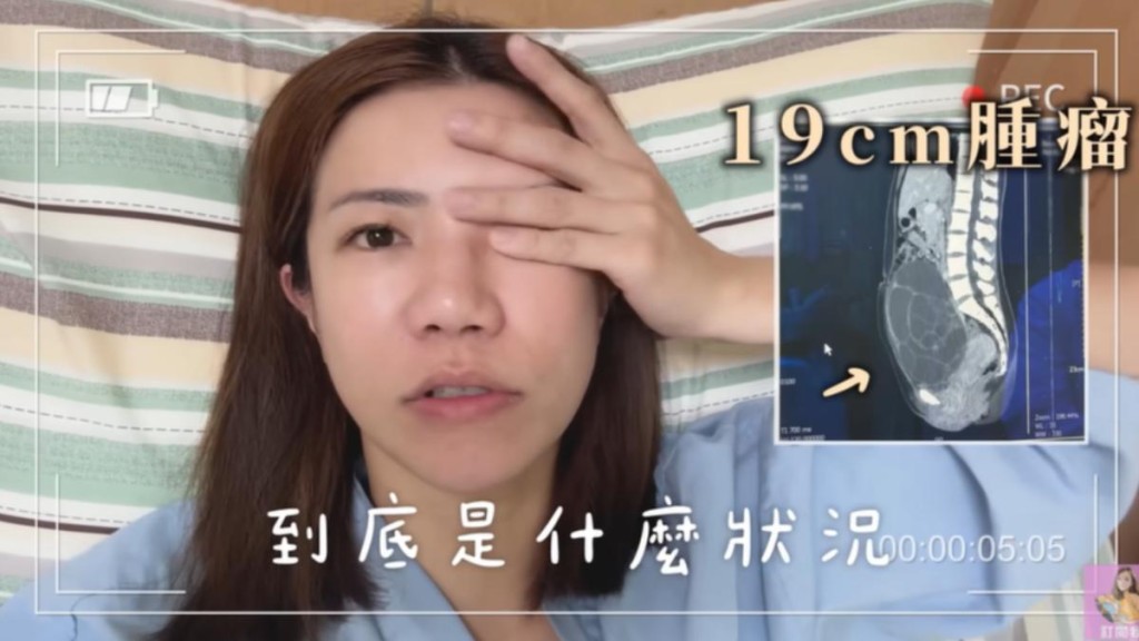 「我是江老師」日前在YouTube上發佈影片透露自己證實罹患卵巢癌一期，並公開整個手術過程，其中還包含醫生開刀的震撼畫面，相當赤裸。