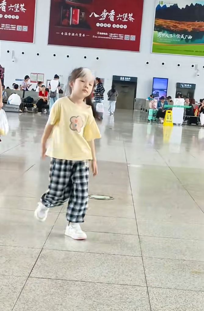 文汐患罕见的“斑驳病”，头上天生显眼的白色浏海。