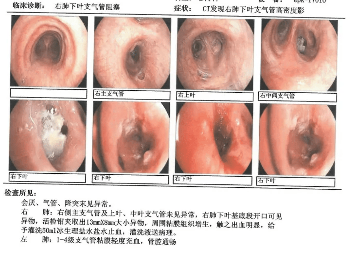 支气管镜检查发现右肺下叶有异物。