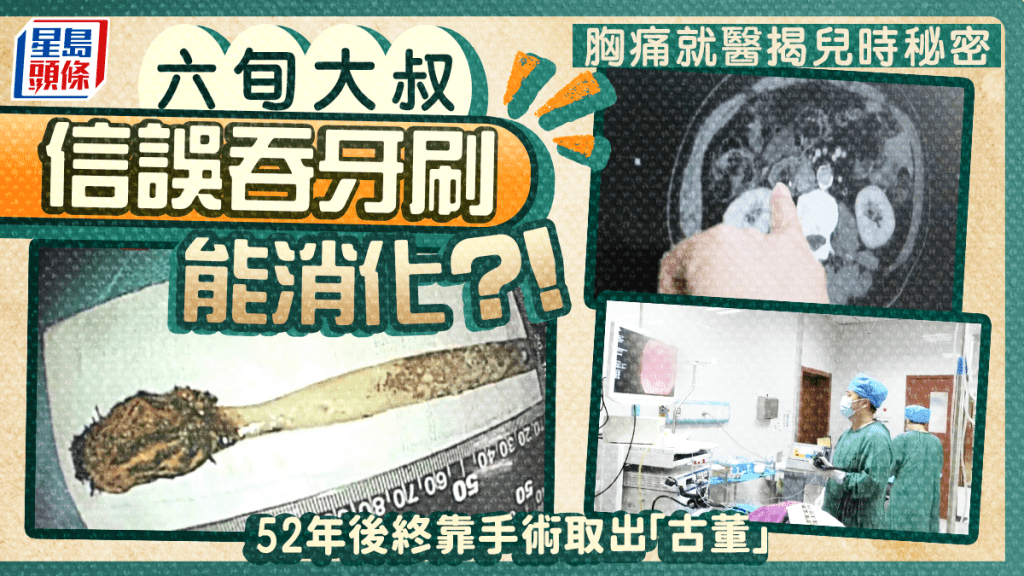 生吞牙刷｜64歲大叔兒時誤以為能消化  絞痛靠手術取52年「古董」