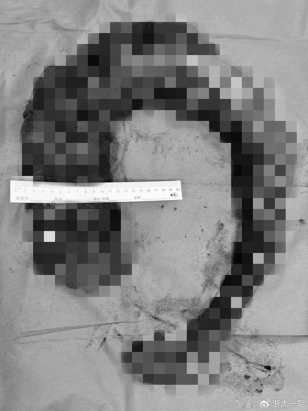 女子手术后被切除1米长结肠。（图片来源：微博）
