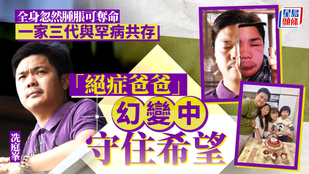 遺傳性血管性水腫(HAE)患者冼庭峯於16歲首次發病,多年來心情幾番起伏,由擔心、絕望到看見曙光和希望。