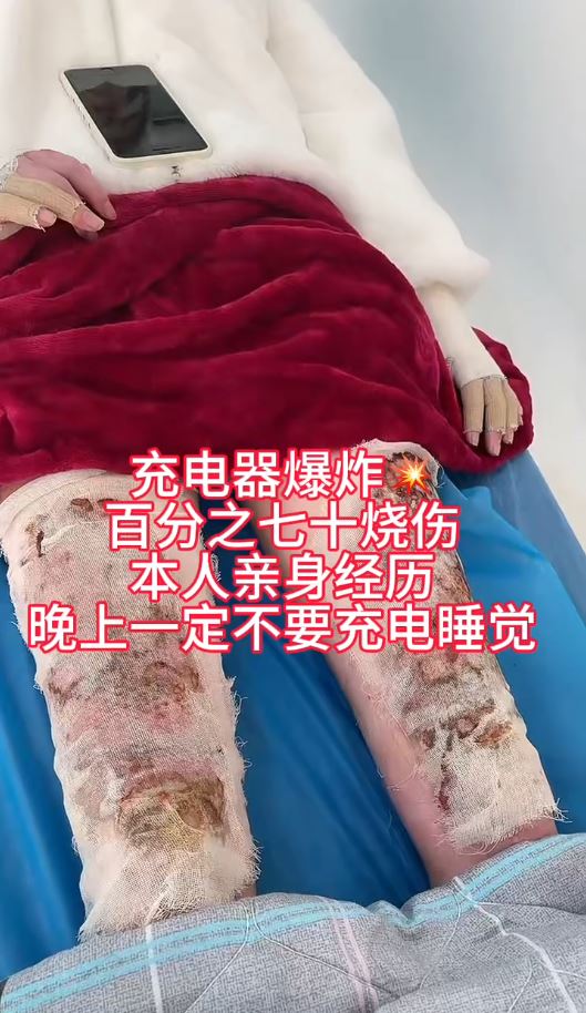 湖北女手機放枕邊通宵叉電，因充電器爆炸燒傷7成皮膚毀容。抖音＠依依的抗疤分享