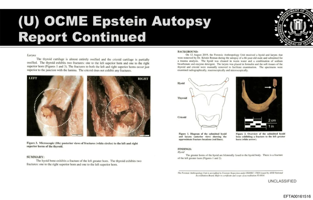 验尸报告显示爱泼斯坦甲状软骨(喉结骨)几乎断裂。 美国司法部 验尸报告显示爱泼斯坦甲状软骨(喉结骨)几乎断裂。 美国司法部