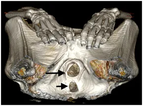 「尖叫木乃伊」會陰部三維CT影像顯示陰道口及肛門口擴張，歞示屍體開口被填料堵塞。 Sahar Saleem