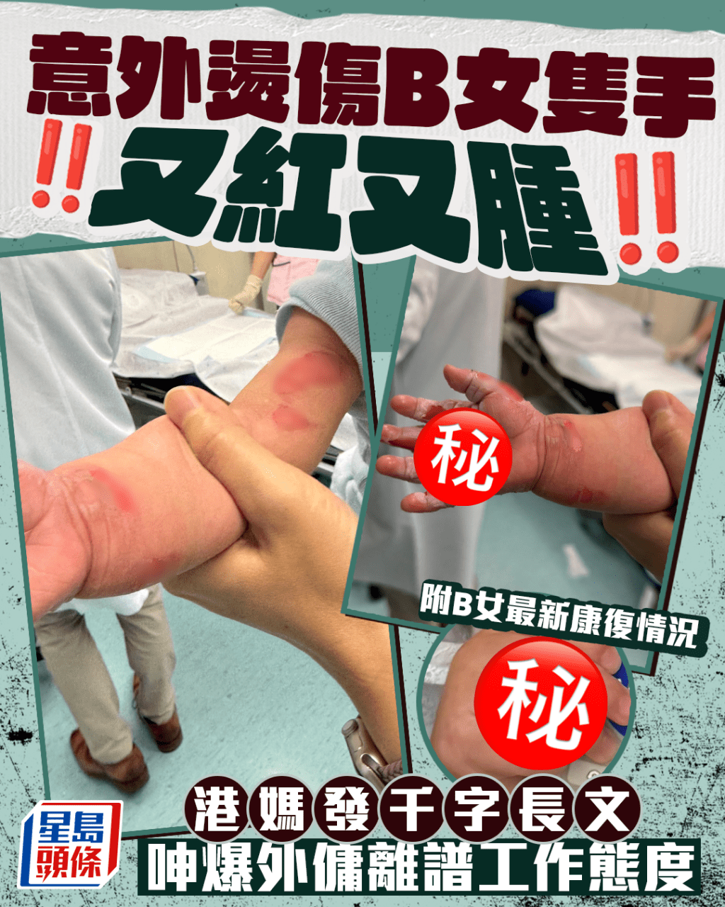 意外燙傷B女隻手又紅又腫 港媽發千字長文 呻爆外傭離譜工作態度 意外燙傷B女隻手又紅又腫 港媽發千字長文 呻爆外傭離譜工作態度