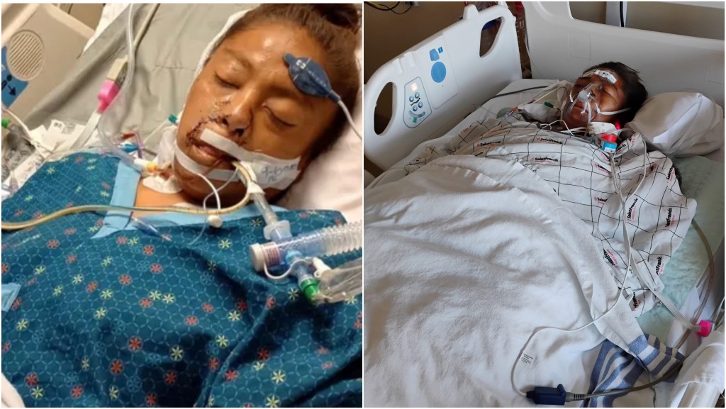 美國奧克拉荷馬州一名女子遭比特犬攻擊，慘截四肢保命。 GoFundMe