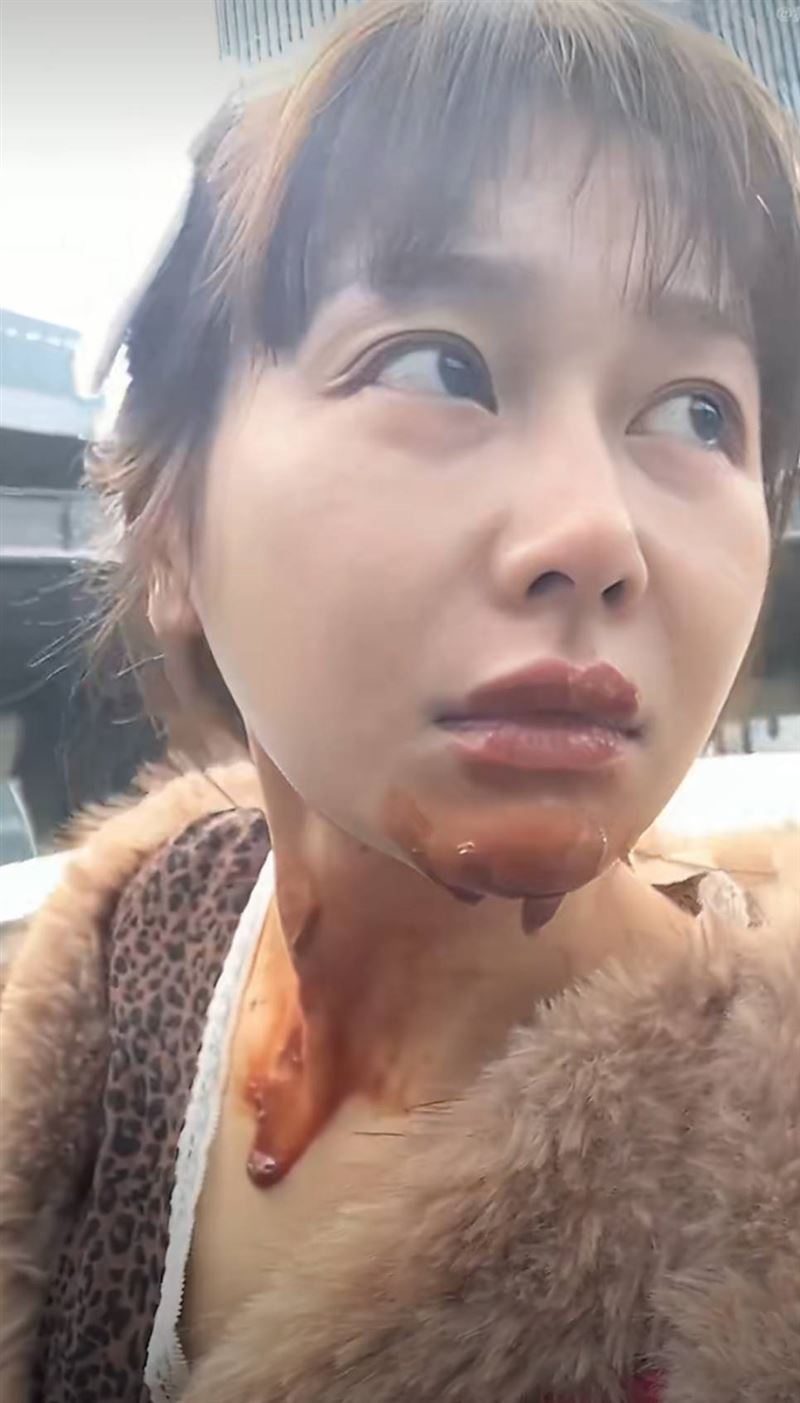 她的下巴及頸部嚴重燒傷，眼睫毛、眉毛及部分頭髮亦被燒焦（王添羽影片截圖）