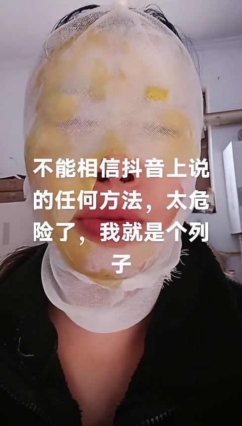 吳女士亂學網紅妙招除水垢，導致面部嚴重燙傷。抖音＠白醋加糖爆炸當事人
