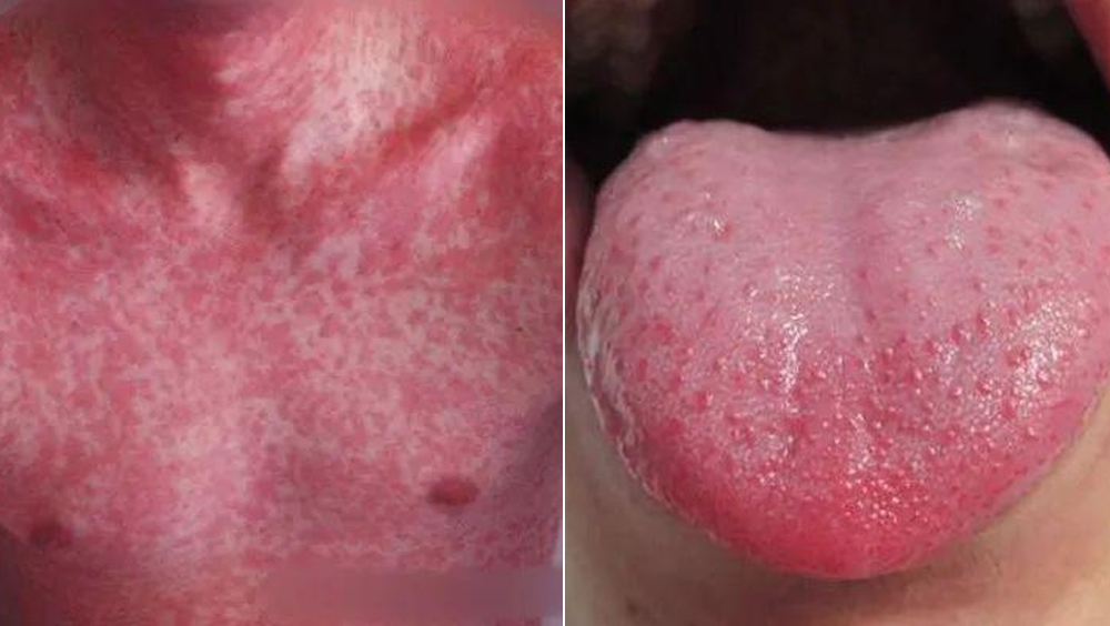 皮疹及「士多啤梨舌」，是猩紅熱最重要的症狀之一。