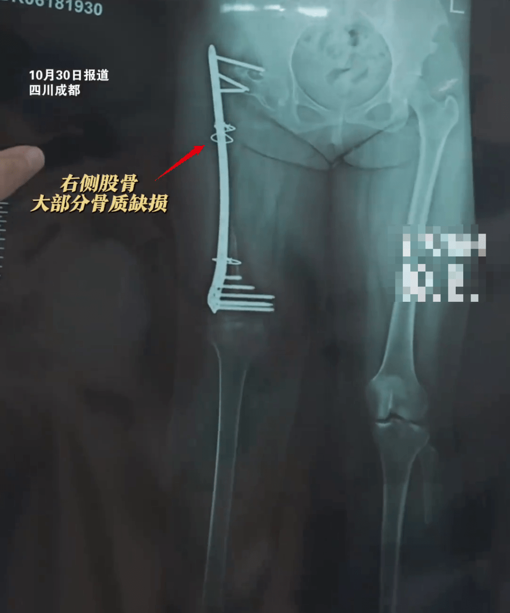 骨溶症女生右大腿部骨頭已全部「消失」。  紅星新聞 骨溶症女生右大腿部骨頭已全部「消失」。  紅星新聞