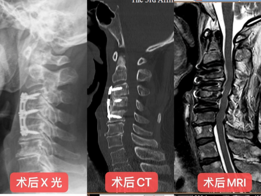 梁叔手术后的技扫瞄照。