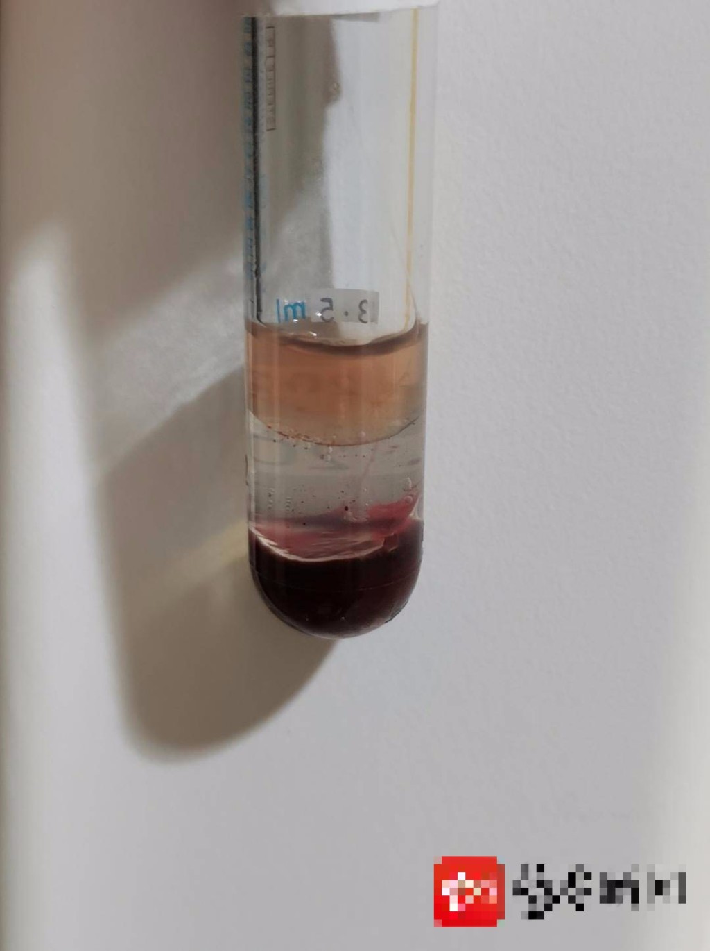 醫護人員早前為小楊楊抽血時，竟意外抽出「牛奶血」。網圖