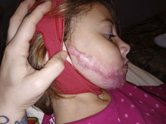 她的疤痕已經癒合不少。