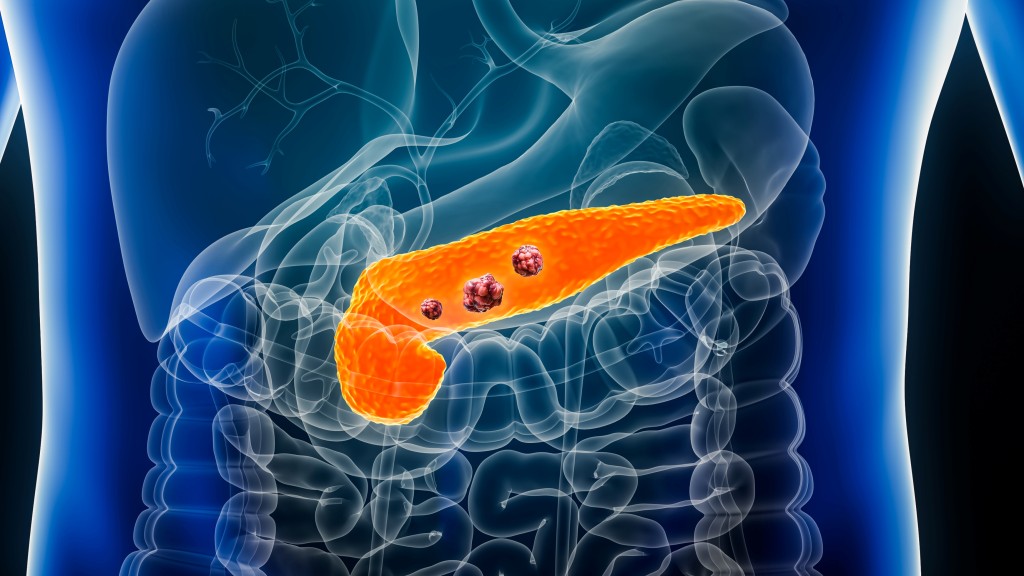 胰臟癌治療現重大突破！西班牙研究揭「三重療法」 有望無抗藥性徹底消除腫瘤