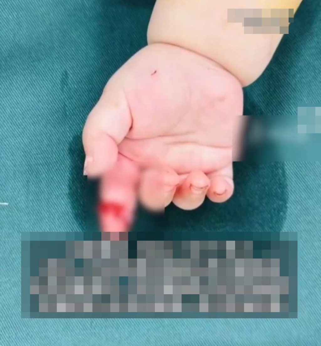 粗心妈用铰剪拆包裹，切断7个月大B女手指。《齐鲁晚报》