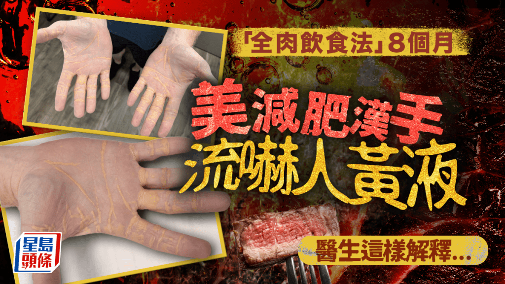美國減肥男採「全肉飲食法」8個月 ,手掌流出嚇人黃色液體。