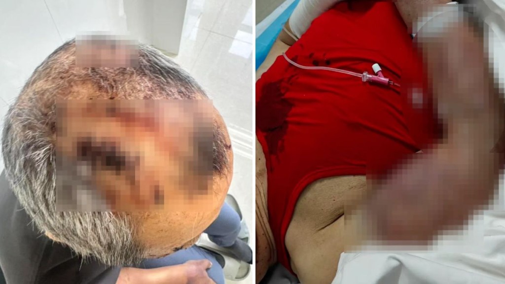 马女士父亲遭安老院室友狂殴2小时。红星新闻