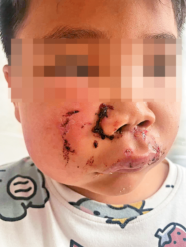 朗朗遭唐狗咬傷臉部，恐會毀容。