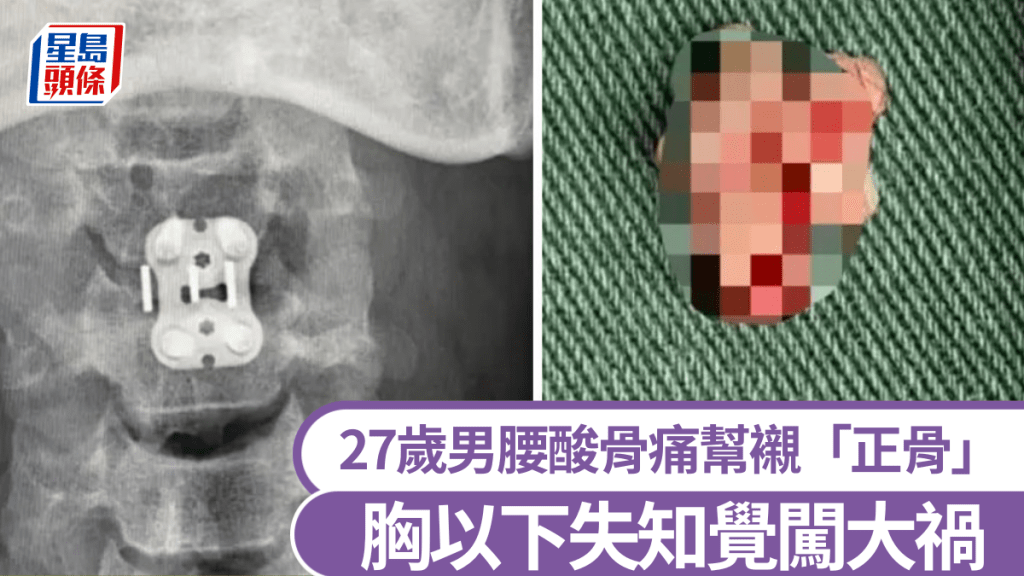 暴力正骨導致頸3-4椎間盤急性突出脫出，醫生摘除病變髓核（右）。《現代快報》