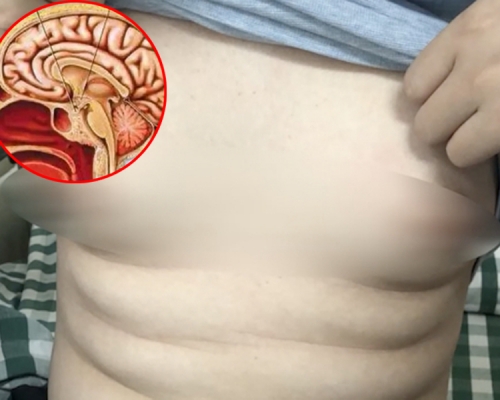 25歲男子胸部腫脹飆乳汁，竟因腦部垂體長瘤。(網圖)