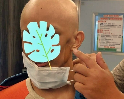 台灣一名姓許的單親爸爸，其14歲的兒子曾經患癌，並曾3度復發，左半部牙齦及牙齒都被癌細胞啃噬，只能將左邊臉削去大半才能保命。網圖