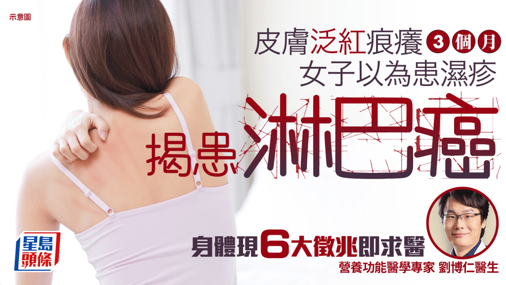 淋巴癌徵兆｜女子皮膚泛紅痕癢3個月 求醫揭患淋巴癌 身體現6大徵兆即求醫