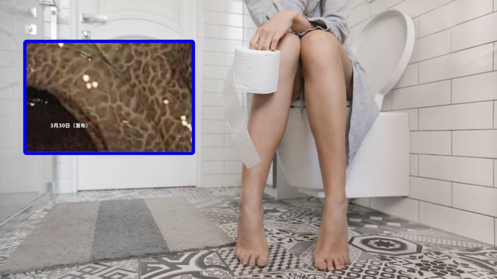 西安有女子十年來靠通便茶減輕便秘問題，結果腸道變成「豹紋」腸（小圖)壞死。iStock