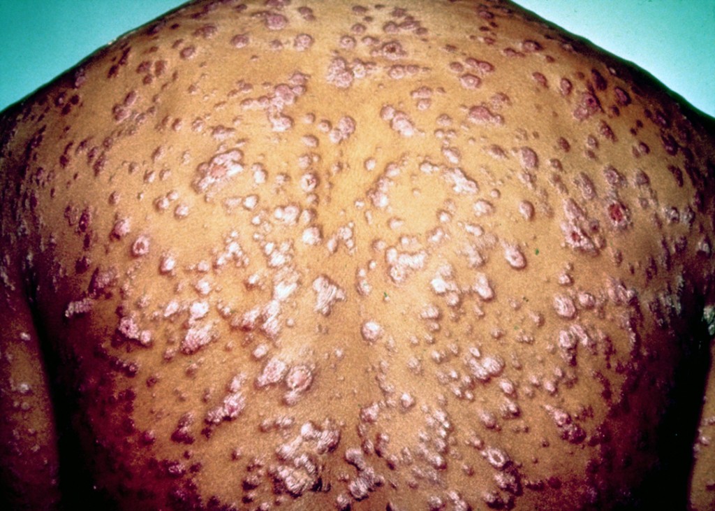 身上許多部位因第二期梅毒出現紅色丘疹及結核。 Wiki