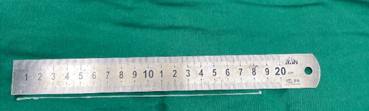 湖南漢生吞蛇膽,致18cm活蟲寄生腦部。金羊網 湖南漢生吞蛇膽,致18cm活蟲寄生腦部。金羊網