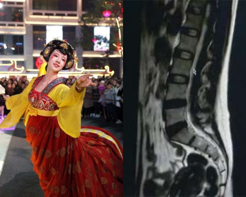 女子模仿當紅「不倒翁女孩」，致腰椎骨折。（網圖） 