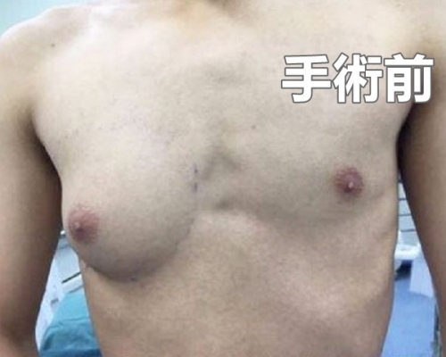 浙江男生小楊，自13歲起左右兩邊乳房發育開始不平衡。網圖