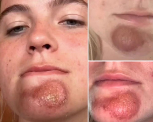 女子網上分享激吻鬍鬚男後，下巴膿瘡潰爛險毀容。網圖