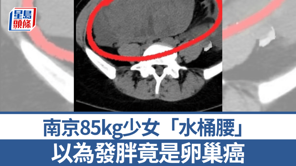 南京85公斤少女「水桶腰 」以為發胖竟是卵巢癌。現代快報