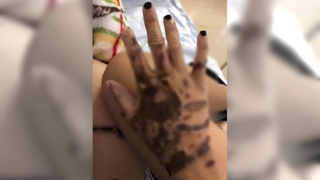 越南男警懷疑妻子出軌潑強酸毀容。網上圖片