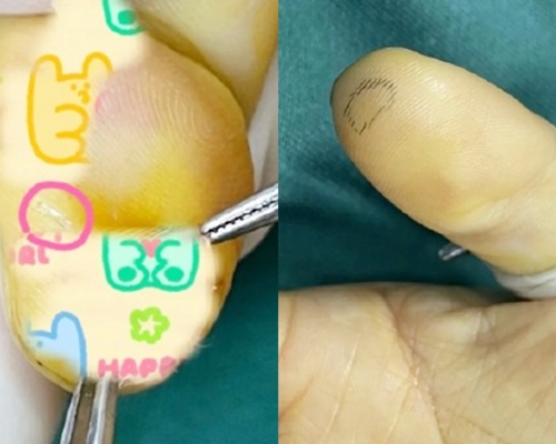 杭州女因手機鋼化玻璃保護貼碎裂懶換，遭碎片插骨致生神經瘤。網圖