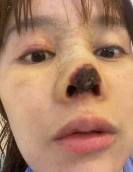 高溜自爆整容失敗鼻尖壞死。(網圖)