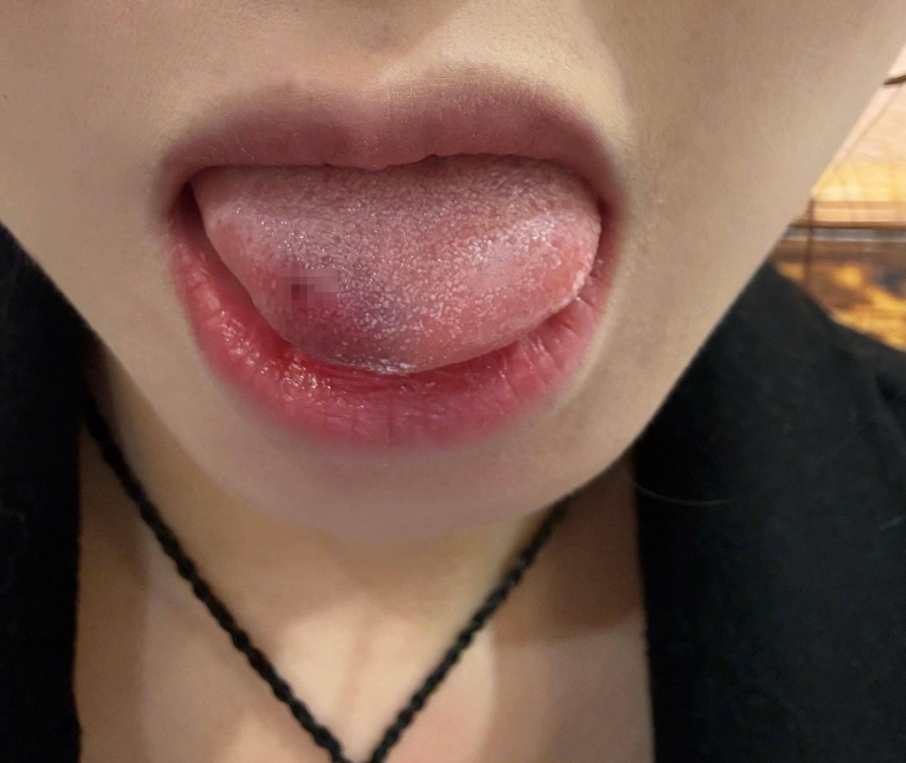 羅小姐吃黃辣丁魚時被其背鯺硬刺插入舌頭,連跑3間醫院才成功「拔骨」。抖音@獨美 羅小姐吃黃辣丁魚時被其背鯺硬刺插入舌頭,連跑3間醫院才成功「拔骨」。抖音@獨美