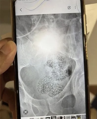 醫生照CT發現體內有多個圓形異物。 星暹日報微信公號 醫生照CT發現體內有多個圓形異物。 星暹日報微信公號