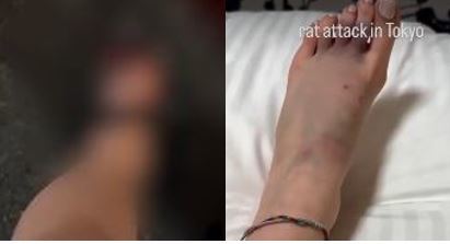 傷者在醫院治療1小時後出院。Instagram