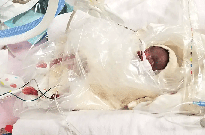 龍鳳胎的男嬰阿德里亞爾，出生時的體重只有420克。健力士官網