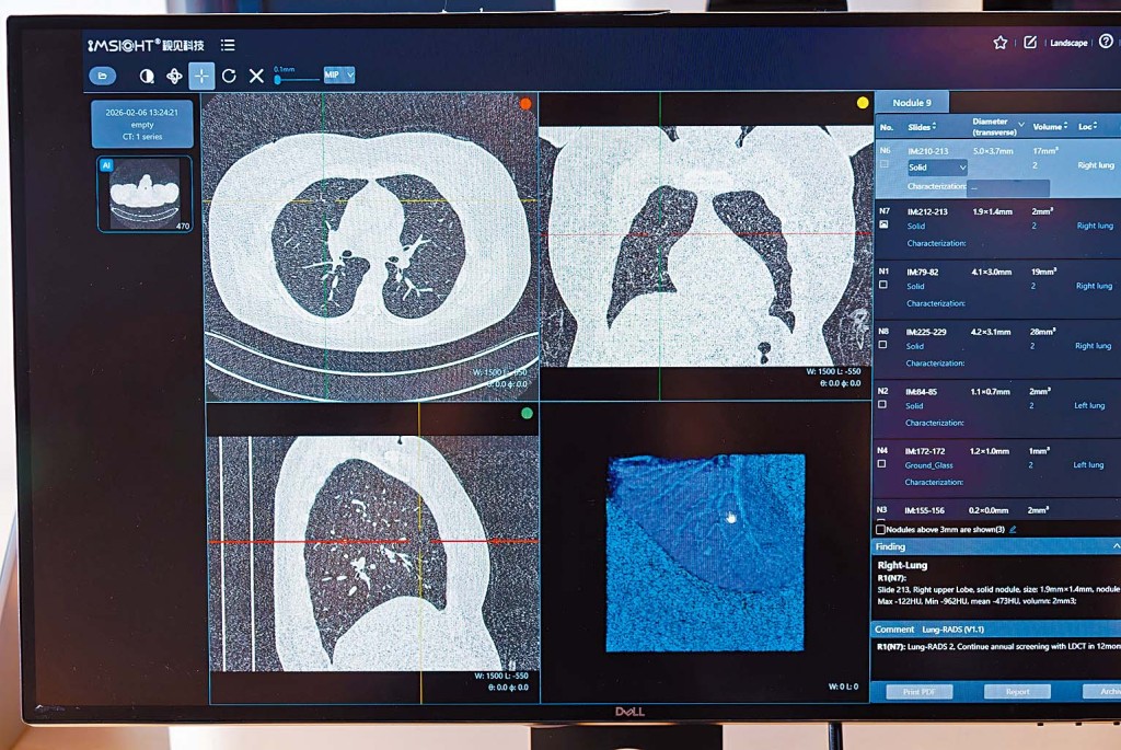 掃描儀將醫學影像轉換為可在顯示屏幕下檢視、分析與管理的數碼病理檔案後，接入AI診斷降低漏診風險，更將傳統2D切片影像重組成3D立體模型，協助醫生更全面地檢視病情。