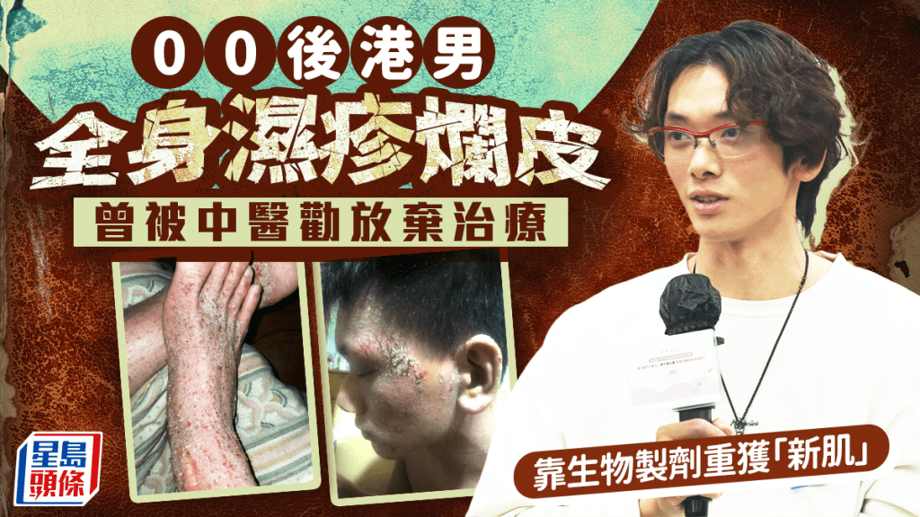 00後港男全身濕疹爛皮 曾被中醫勸放棄治療 靠生物製劑重獲「新肌」