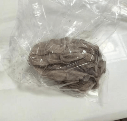 手術取出的紗布。大皖新聞