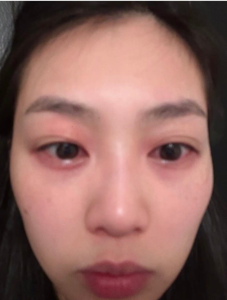 有份拍《俠醫》的郭柏妍日前食物敏感入院治療,對眼腫晒。 有份拍《俠醫》的郭柏妍日前食物敏感入院治療,對眼腫晒。